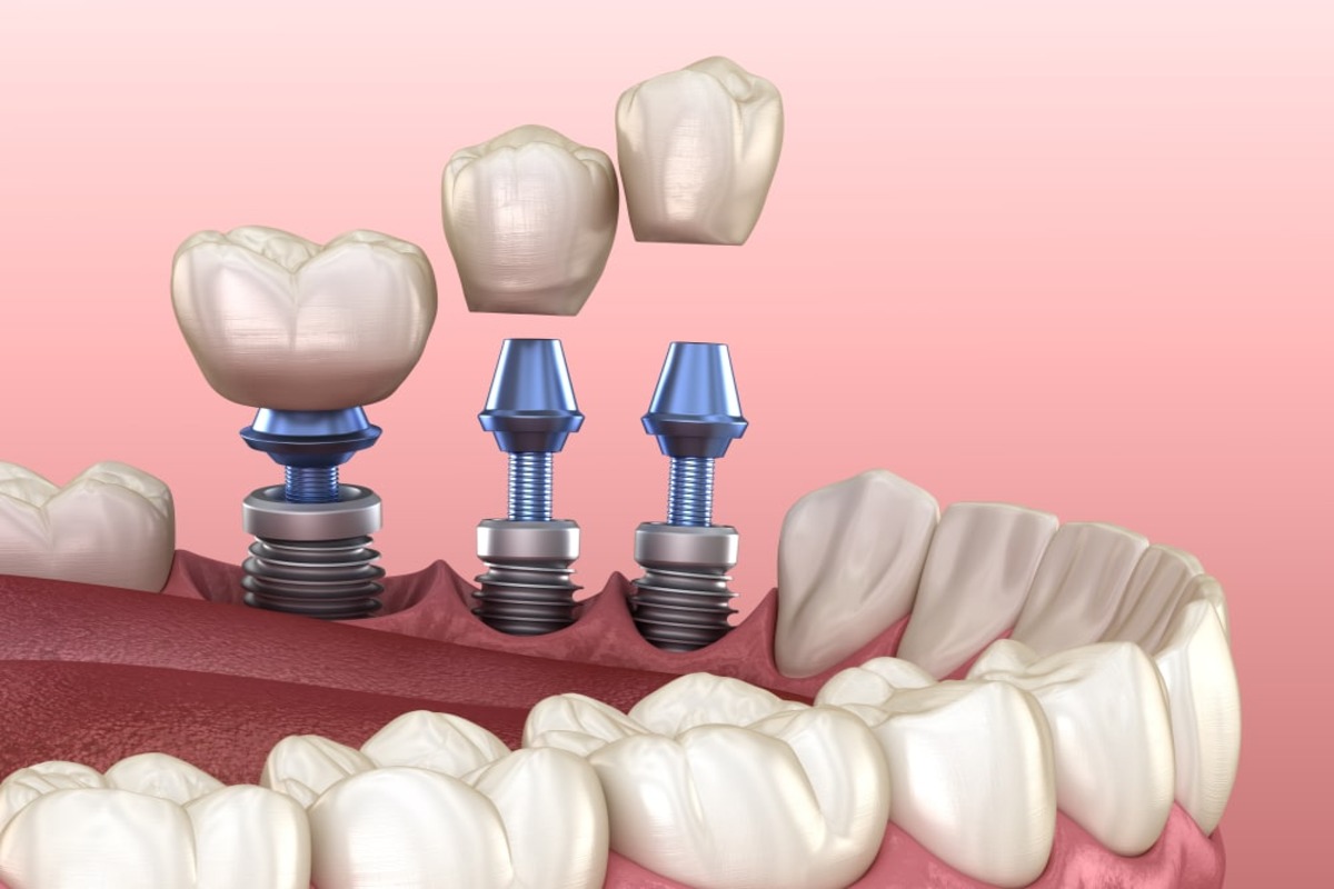 Impianti Dentali in albania