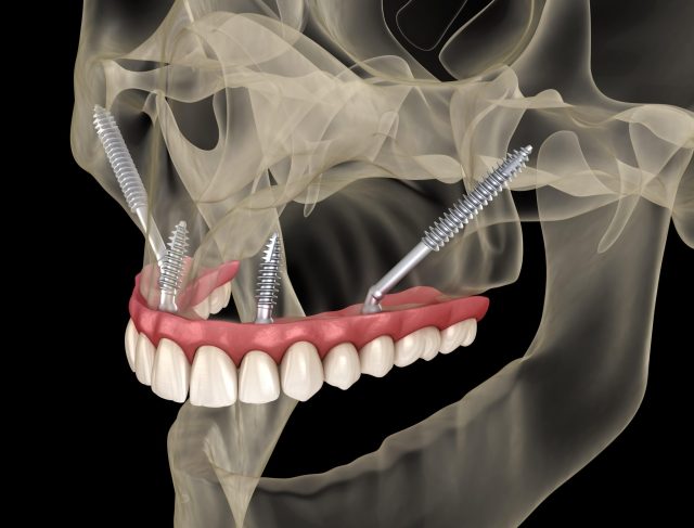 Migliori Materiali per Impianti Dentali