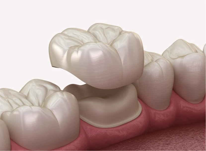 https://platinum-dental-center.com/wp-content/uploads/2024/11/Corone-dentali.webp