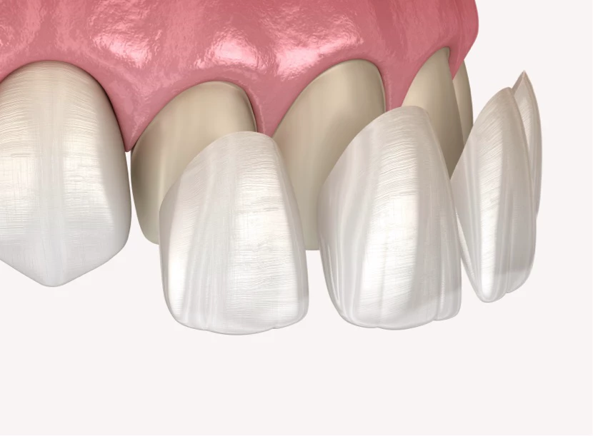 https://platinum-dental-center.com/wp-content/uploads/2024/11/Faccette-dentali.webp