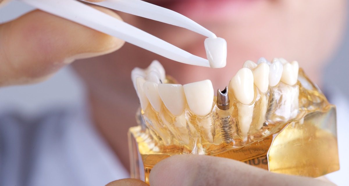 Rigetto Impianto Dentale: Esiste Davvero o È Solo un Mito?