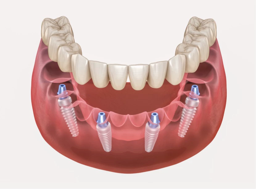 https://platinum-dental-center.com/wp-content/uploads/2024/11/all-on-4-intro-2.webp