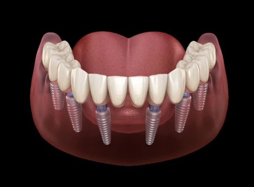 https://platinum-dental-center.com/wp-content/uploads/2024/11/impianti-dentali-carico-immediato-all-on-six.webp