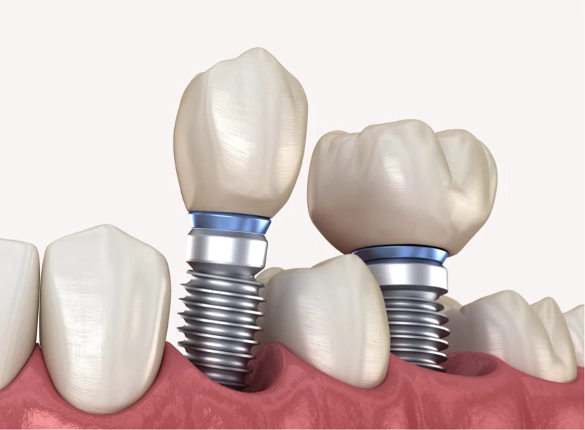 https://platinum-dental-center.com/wp-content/uploads/2024/11/impianti-dentali.webp