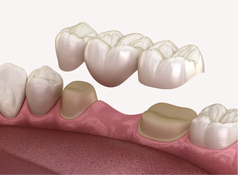 https://platinum-dental-center.com/wp-content/uploads/2024/11/ponti-dentali.webp