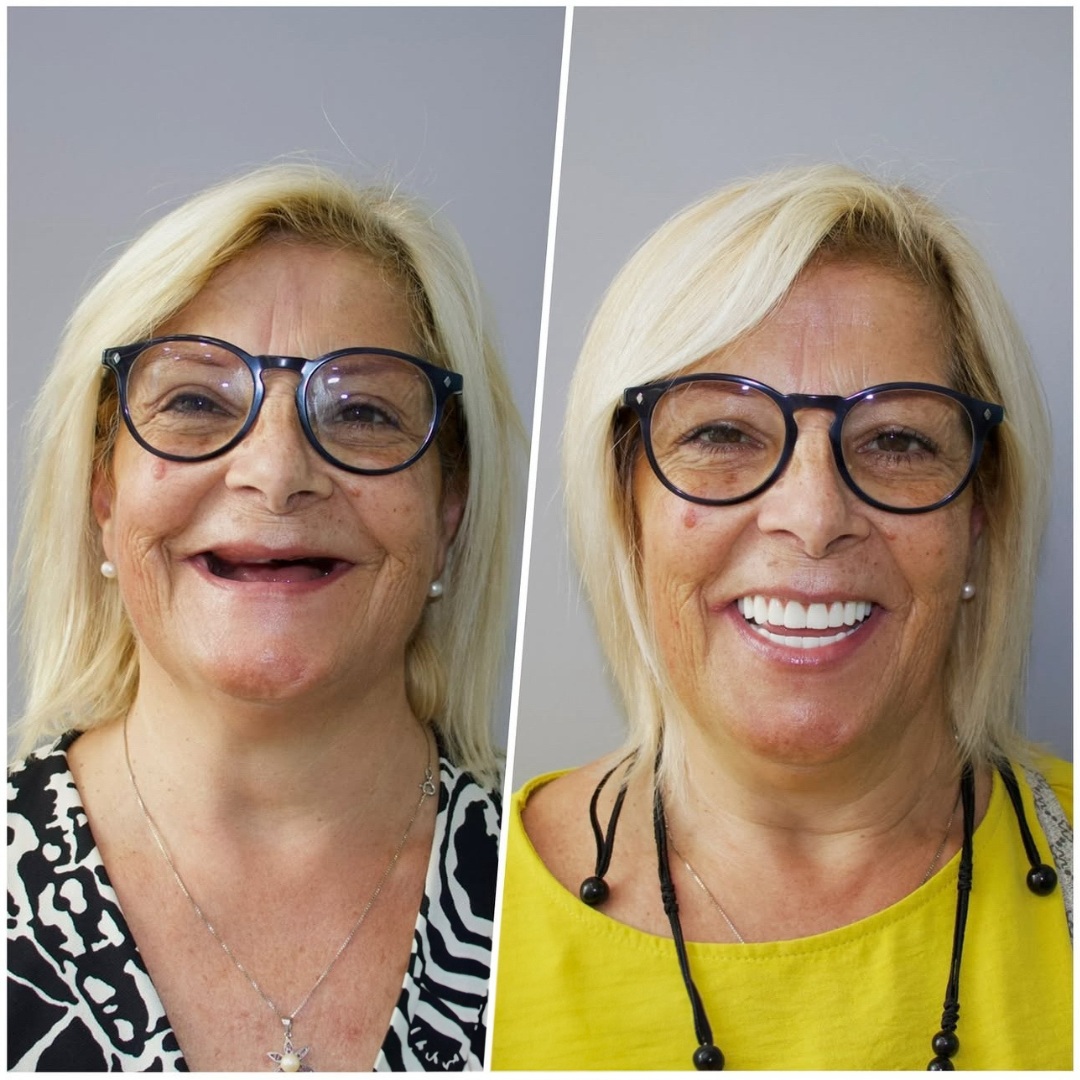 Platinum Dental Center - Prima & Dopo